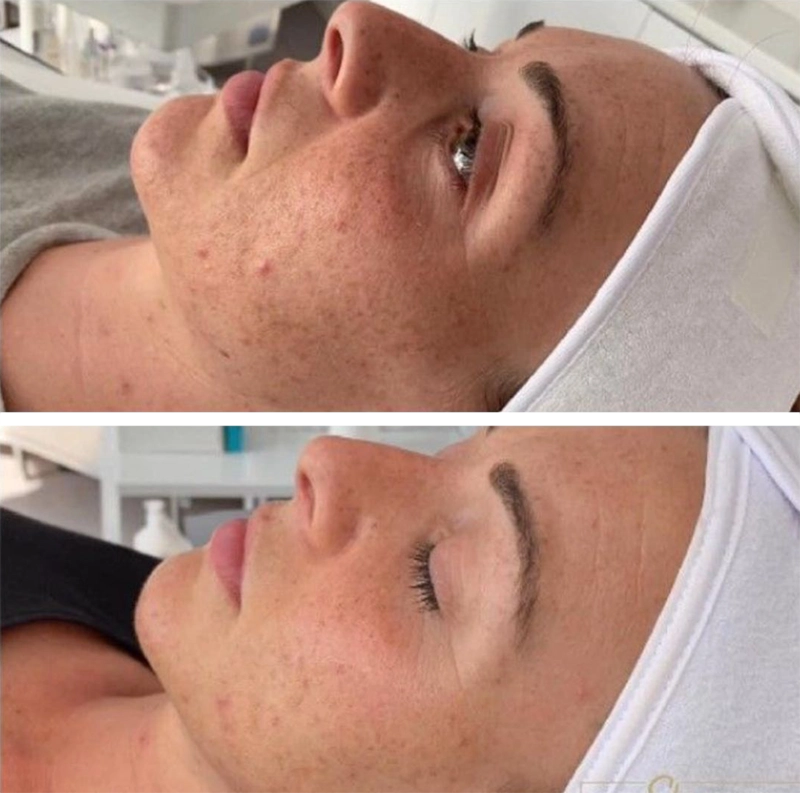 Celluma LED Light Therapy